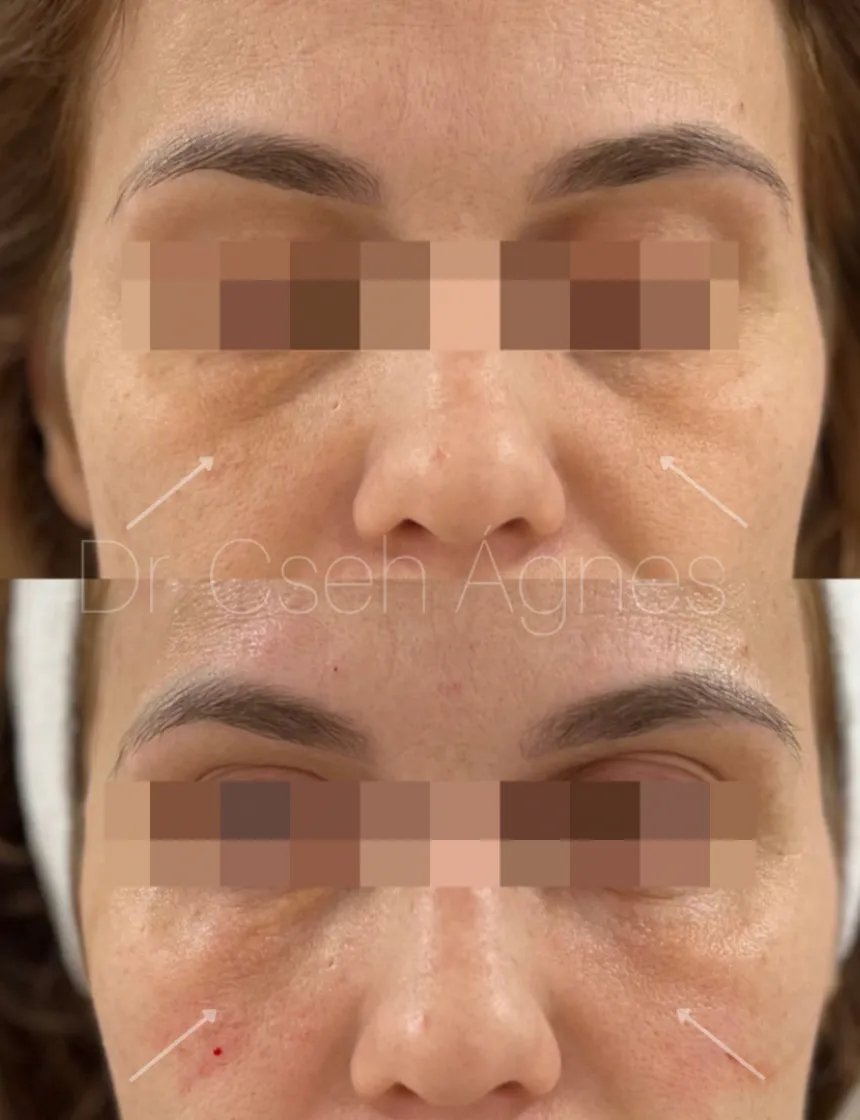 Botox insta