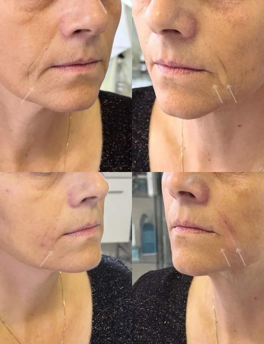 Botox insta 6