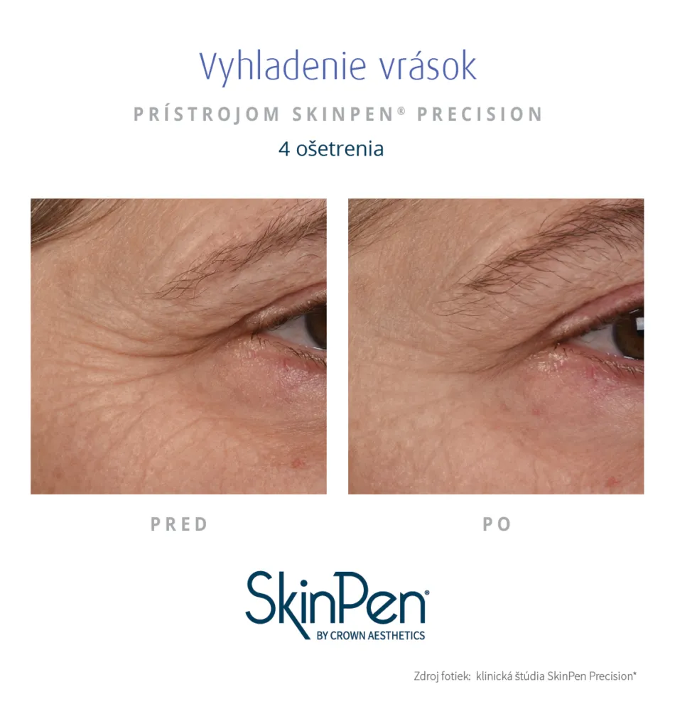 Skin Pen vysledky osetrenia vrasky 1